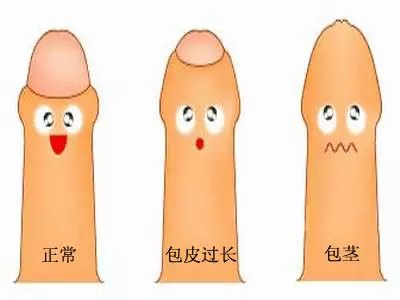 包皮过长危害,包皮过长图片,包皮过长早泄,包皮过长原因