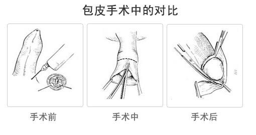 割包皮多少钱,割包皮时间,包皮包茎,割包皮费用